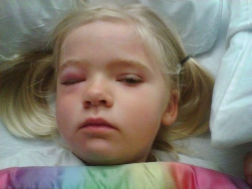 Young girl with swollen eyes from allergies